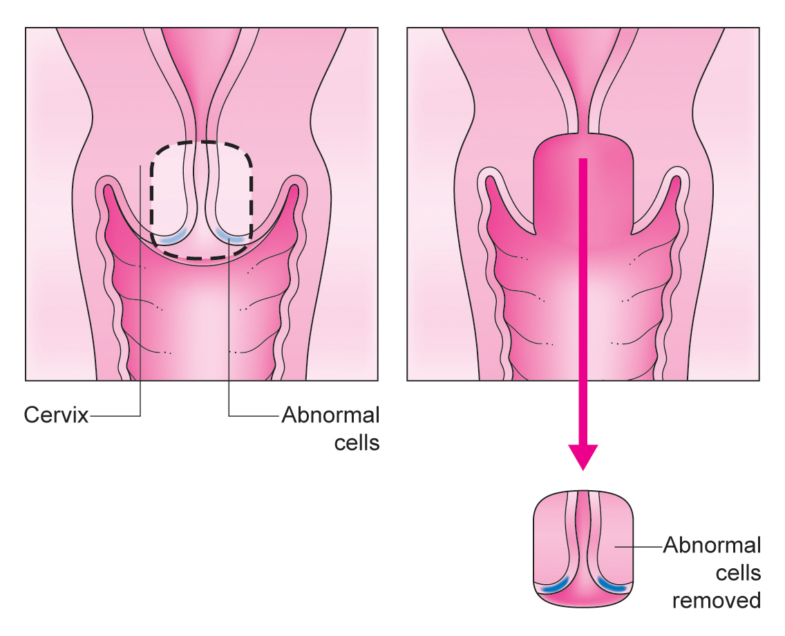 Cone Biopsy Diagram Illustration 