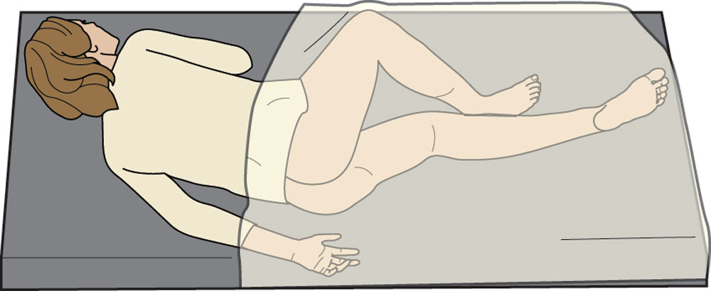 An illustration of a patient lying in the left lateral position.