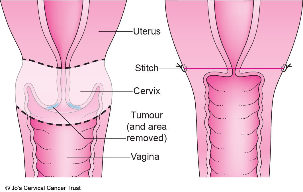 An illustration of the cervix, top of the vagina and bottom of the womb showing the area that trachelectomy surgery removes.