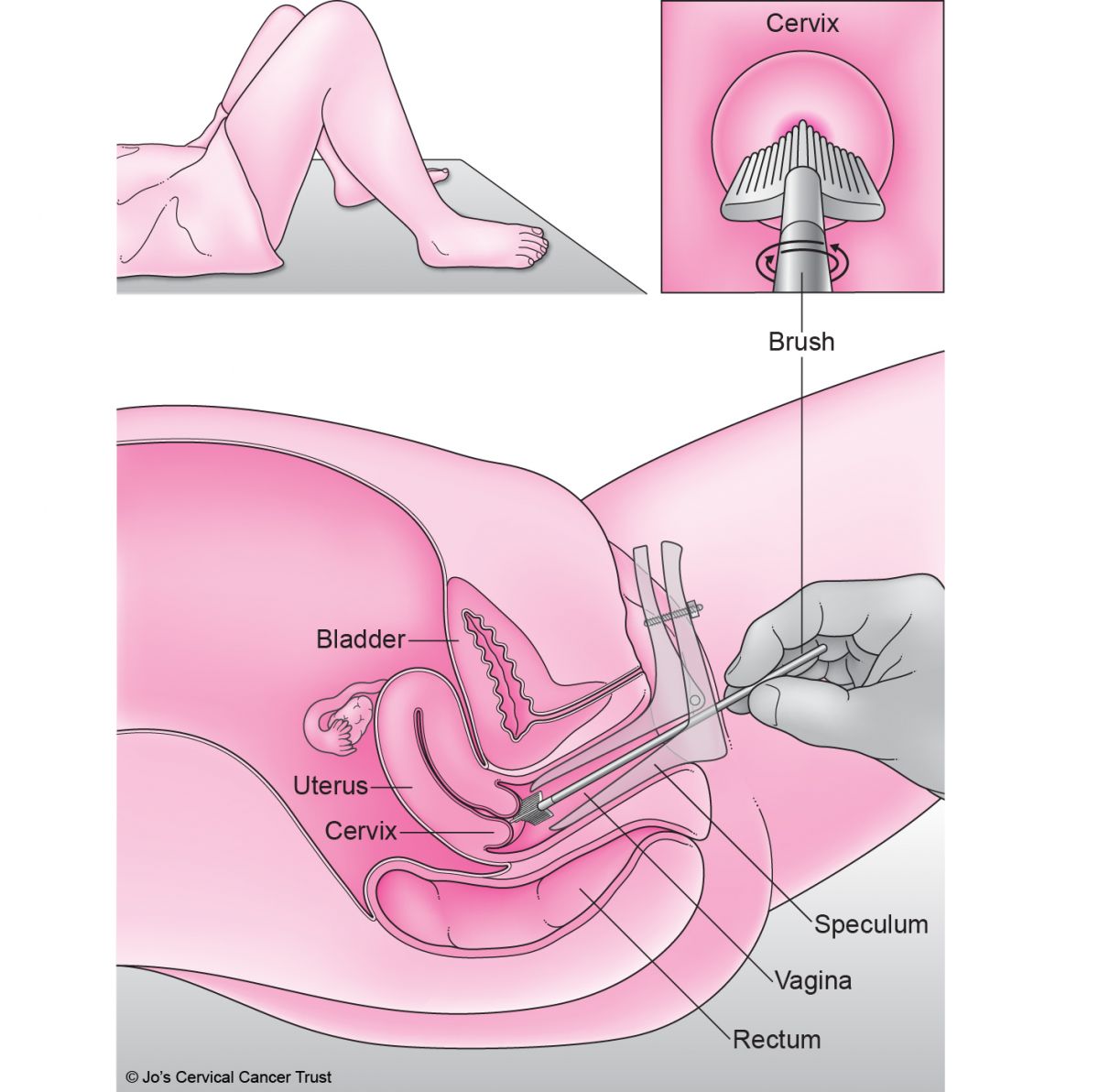 Someone lying back on an examination bed. A nurse has gently put a speculum inside the person's vagina to see the cervix, so they can take a sample of cells.