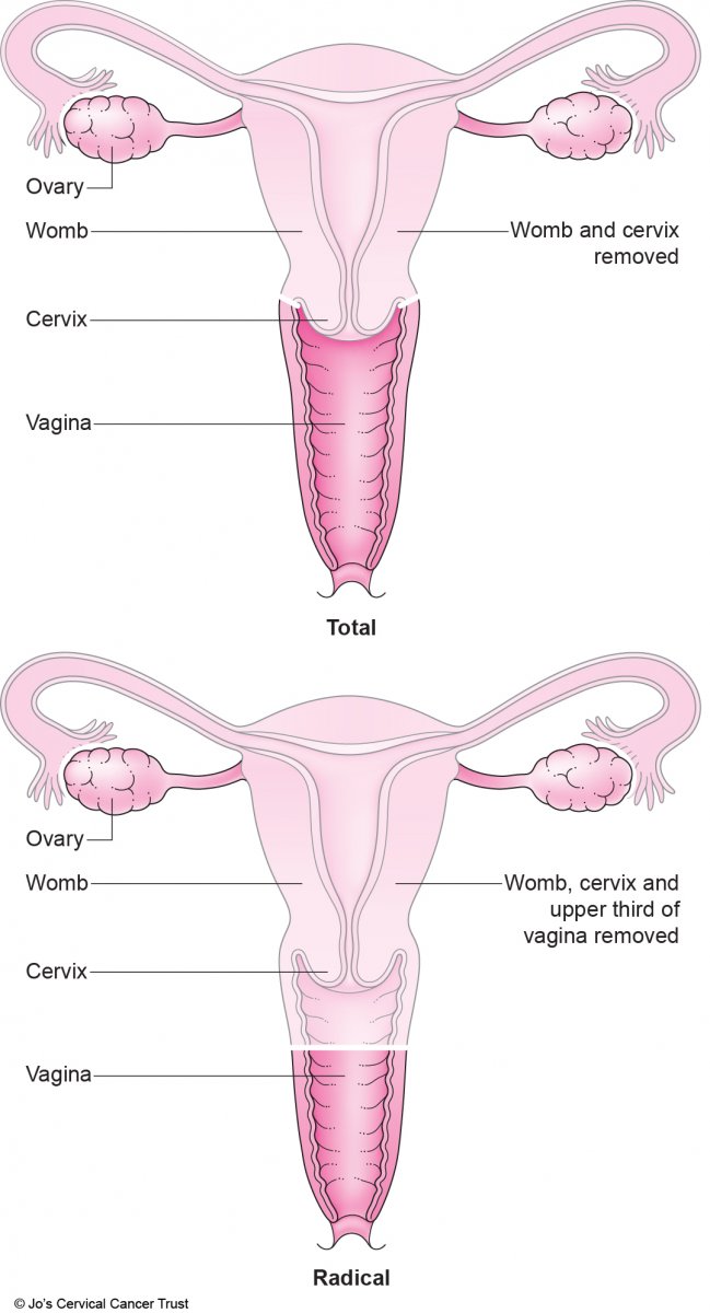 An illustraction of two types of hysterectomy showing which parts of the female reproductive system are removed via surgery. 