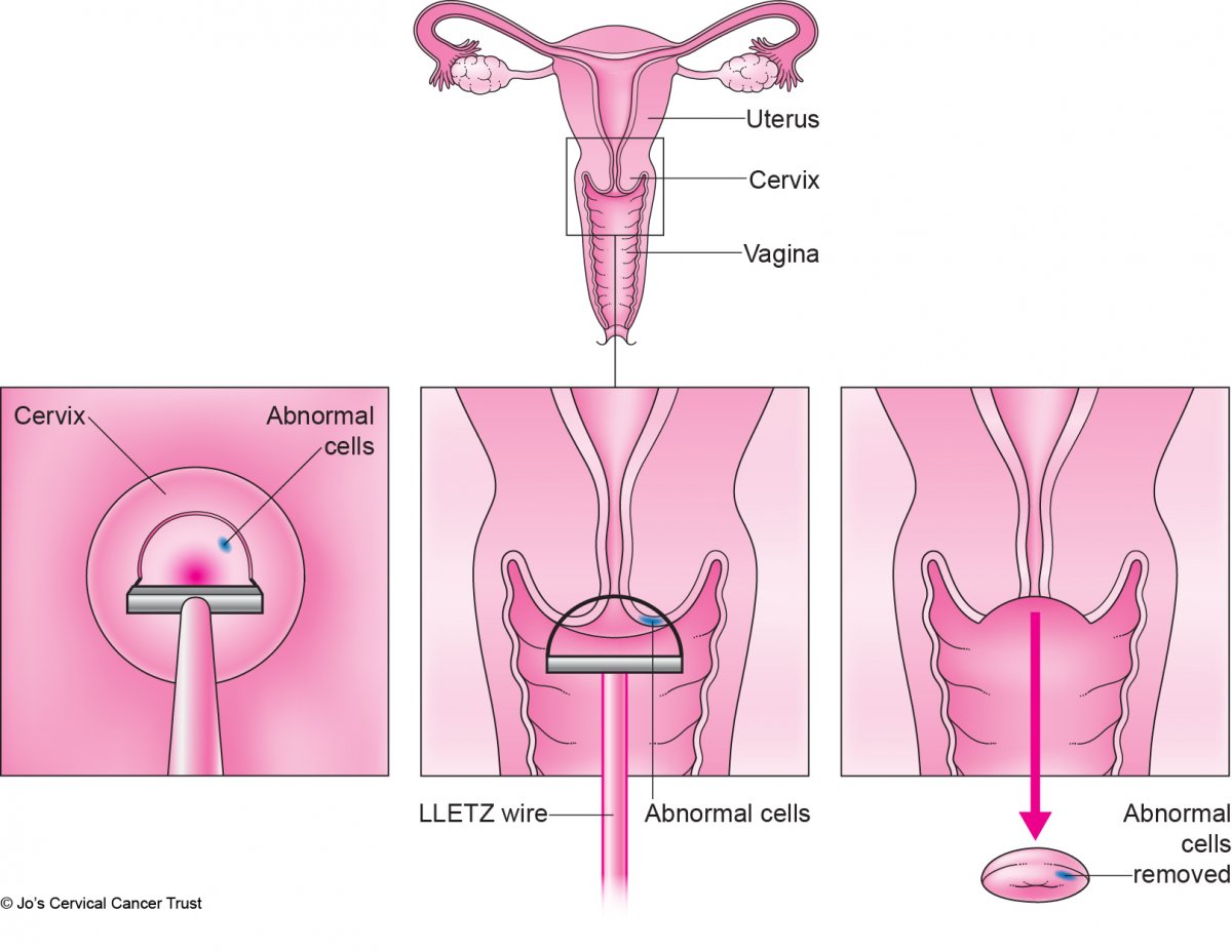 An illustration of the female reproductive system. The cervix is emphasised with a box around it. It shows part of the cervix being removed with a thin wire loop.