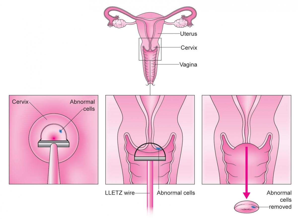 LLETZ procedure 