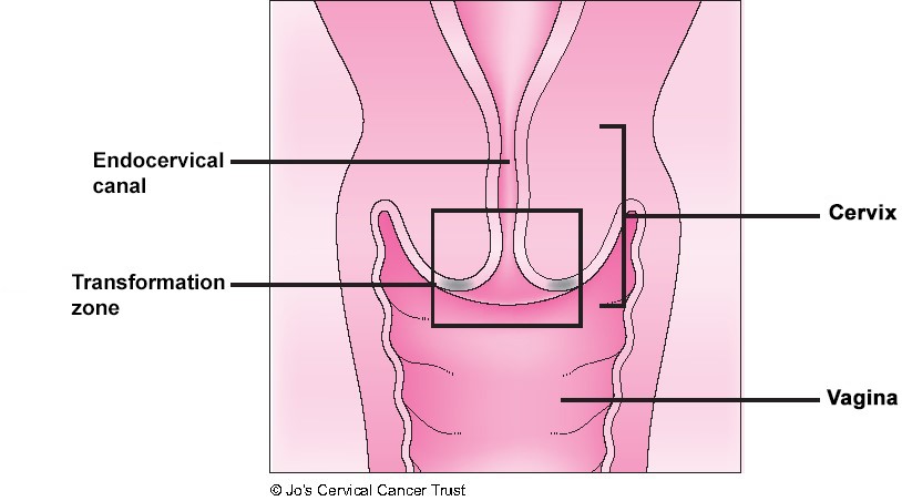 An illustration of the cervix showing where cells are taken during cervical screening. It is called the transformation zone.